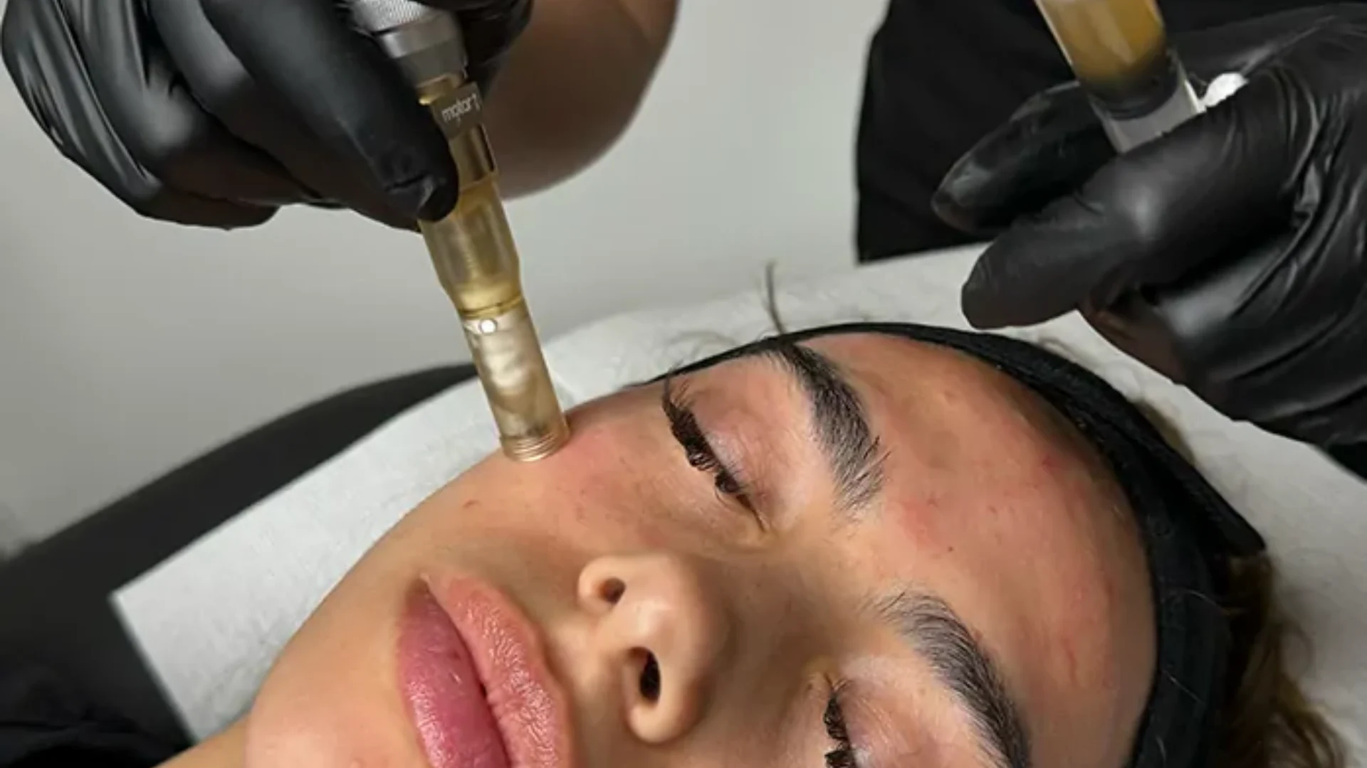 Microneedling works for both scarring and aging like this procedure shown at FACE/FIT in Houston
