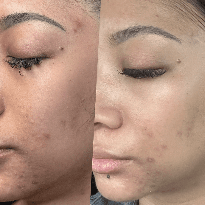 ADVA ACNE