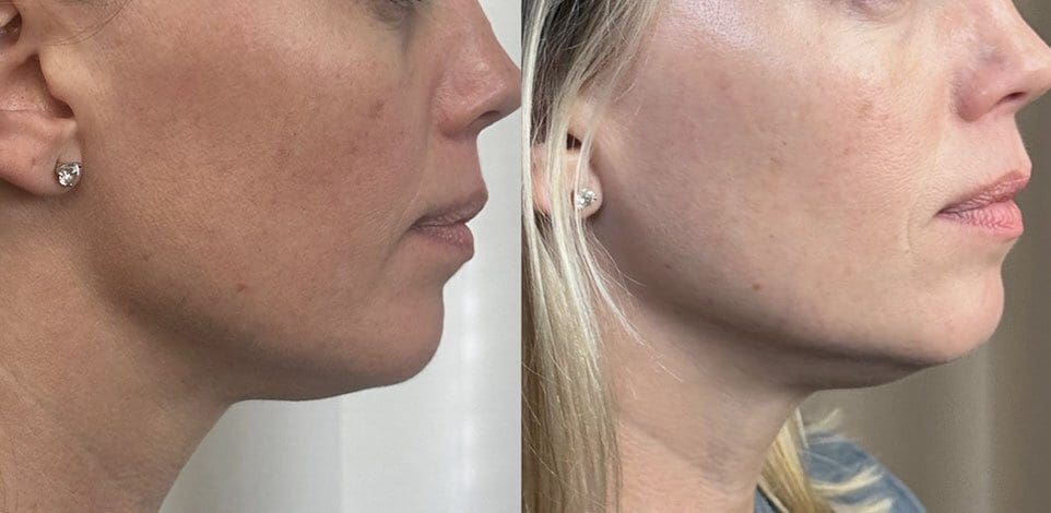 sculptra